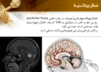 تومورهای مغز (All about Brain Tumors)
